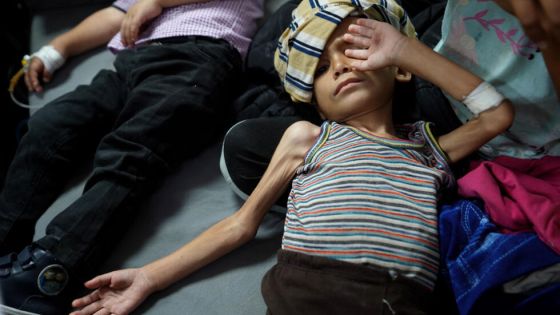 وفاة طفلين شمال وجنوب قطاع غزة بسبب سوء التغذية والمجاعة