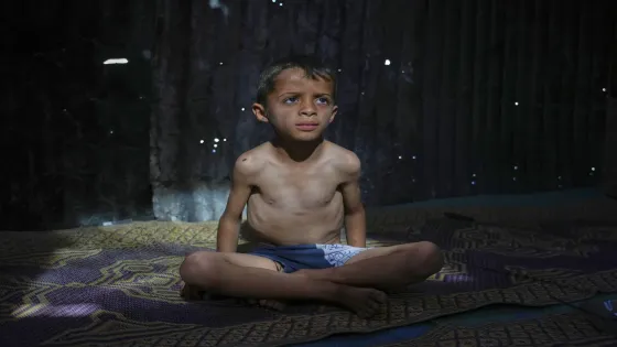 أطباء بلا حدود: مستويات مقلقة من سوء التغذية في غزة