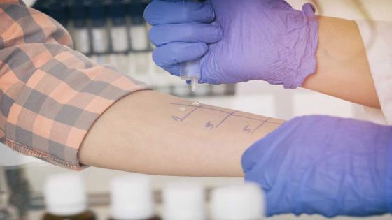 تحذير من فحوصات حساسية وهمية في الأردن