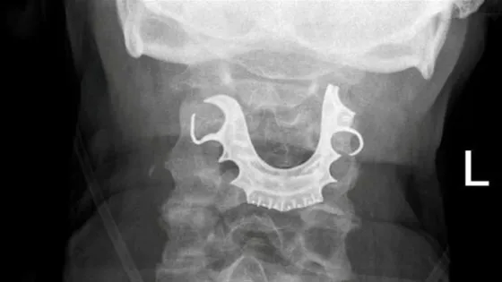 توجيه عن بُعد ينقذ سيدة من الاختناق في اللحظات الحرجة