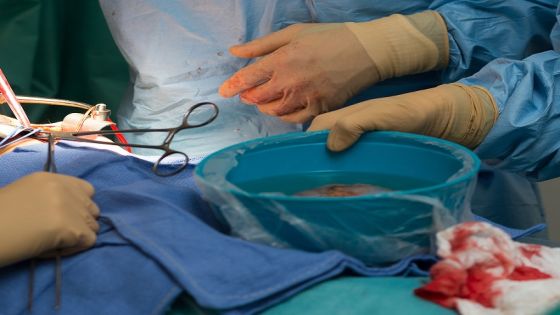 Kidney transplant in the urology, Nice, France, kidney is taken from a living related donor, the recipient's wife Transplanting the kidney in the recipient. (Photo by: BSIP/Universal Images Group via Getty Images)