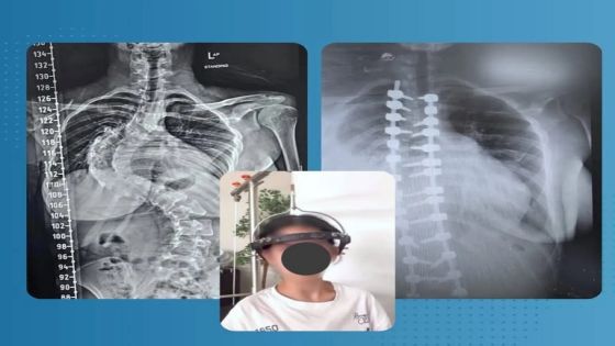 إنجاز طبي جديد في جراحة العمود الفقري بمستشفى حمزة