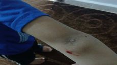 طفل يتعرض لعضة كلب ضال في منتزه للأطفال بالكرك