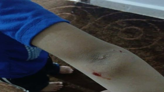 طفل يتعرض لعضة كلب ضال في منتزه للأطفال بالكرك