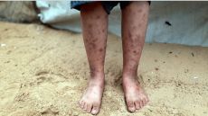 القوارض والأوبئة الجلدية تغزو خيام النازحين في قطاع غزة