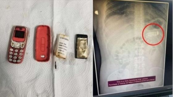 واقعة غريبة.. رجل يبتلع هاتف نوكيا 3310 ويخضع لعملية جراحية