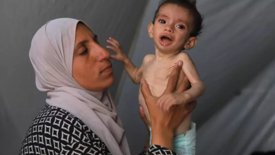 303 حالات وفاة في غزة من ضمنها 117 طفلا بسبب الجوع