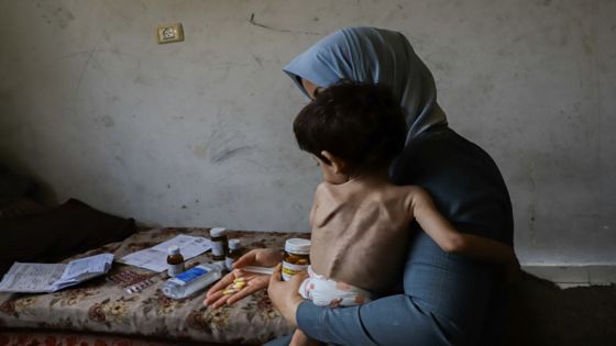 Mother of the 3-year-old child Amjed Al-Qanooa, who suffers from severe malnutrition, shows the pills prescribed for her son in the Jabalia Camp in northern Gaza on June 9, 2024. Al-Qanooa, who suffers from severe malnutrition, weighs 5 kg, and signs of malnutrition are visible on his body and face. Palestinian children are increasingly suffering from severe malnutrition and dehydration amid Israeli attacks on the densely populated Gaza Strip. (Photo by Abood Abusalama / Middle East Images / Middle East Images via AFP) (Photo by ABOOD ABUSALAMA/Middle East Images/AFP via Getty Images)