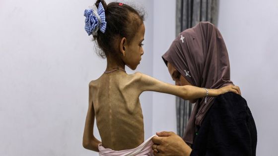 تسجيل 6 وفيات جديدة نتيجة المجاعة وسوء التغذية في غزة