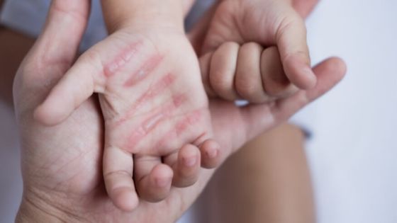 طفـــل ضحية حرق يصارع الالم وحيداً في مستشفى الزرقاء الحكومي