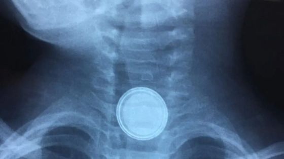 بطارية تفقد طفلا الحركة ومستشفيات البشير توضح