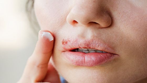 Part of a young woman's face with a virus herpes on lips, treatment with ointment